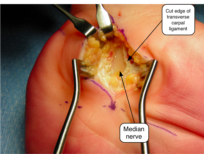 When to Consider Carpal Tunnel Surgery NZ for Persistent Hand Pain